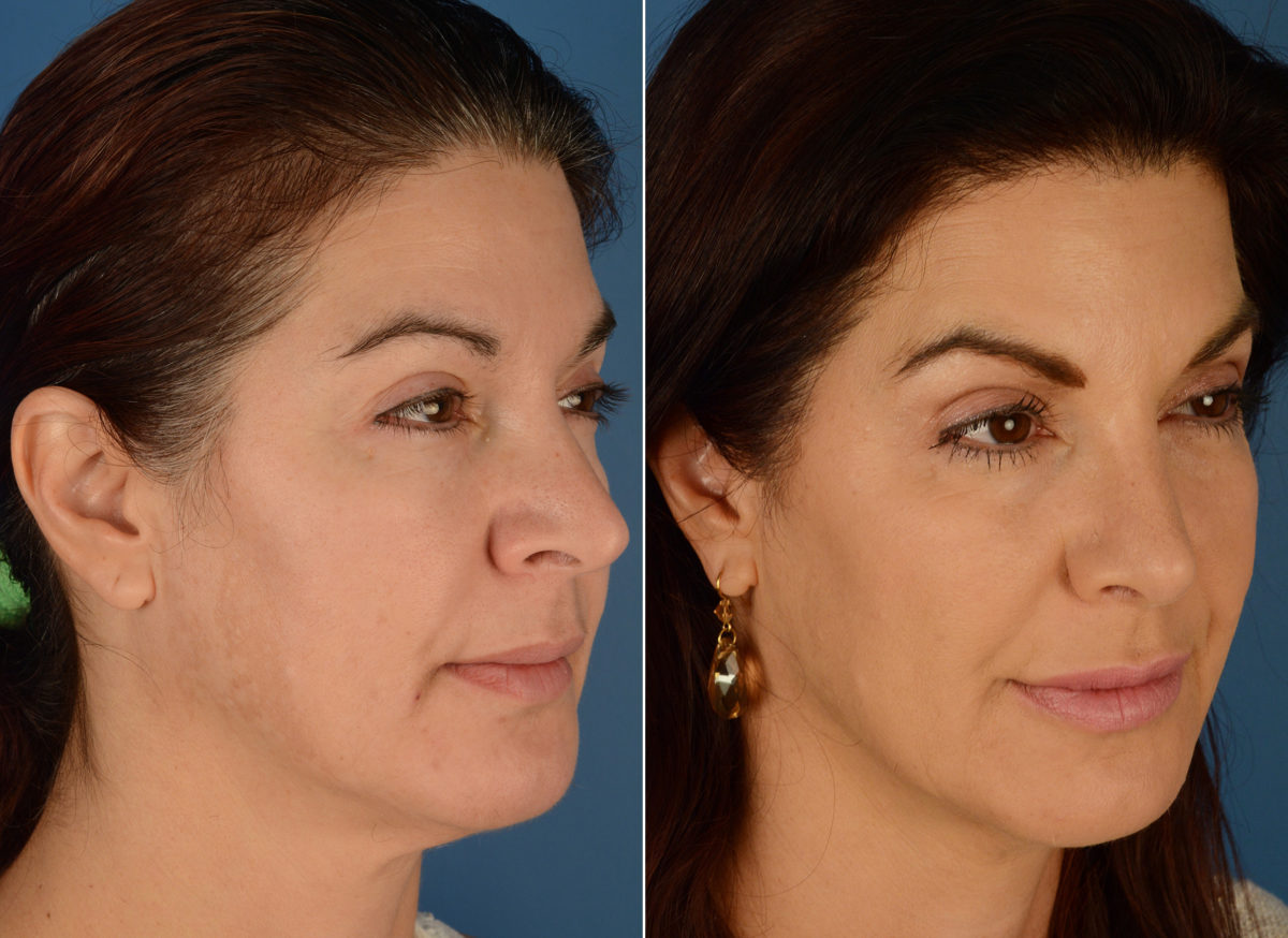 Revision Rhinoplasty Before and After Photos in Naples, FL, Patient 12593