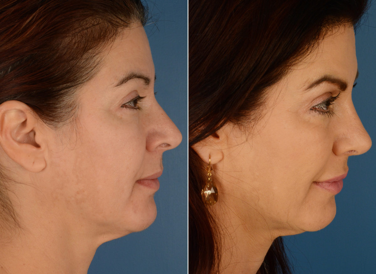 Revision Rhinoplasty Before and After Photos in Naples, FL, Patient 12593