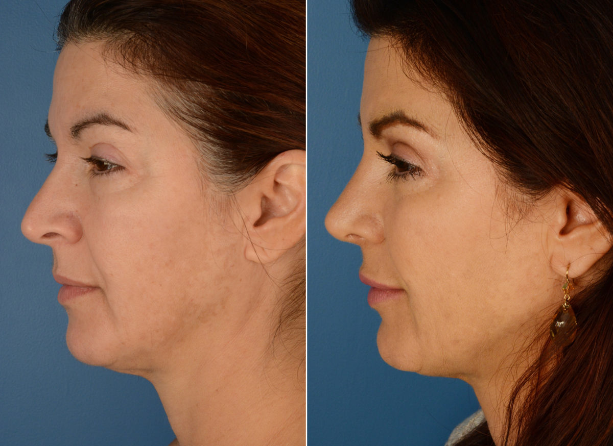 Revision Rhinoplasty Before and After Photos in Naples, FL, Patient 12593