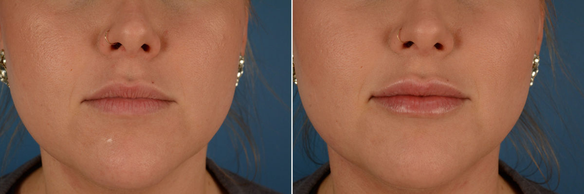 Injectable Fillers Before and After Photos in Naples, FL, Patient 12611