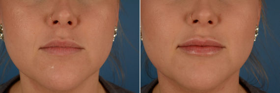 Injectable Fillers Before and After Photos in Naples, FL, Patient 12611