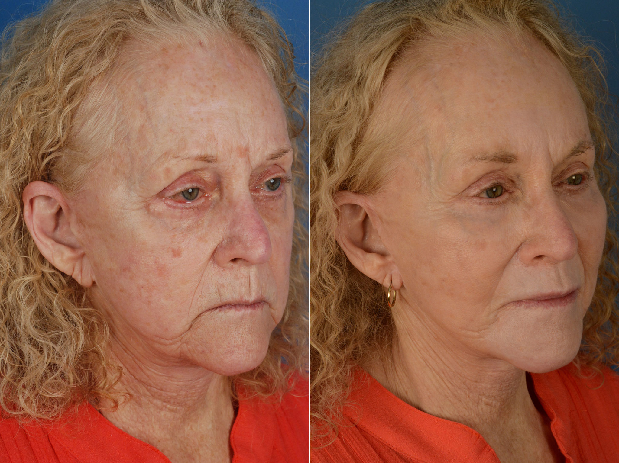 Endoscopic Facelift Photos Naples, FL Patient 12660