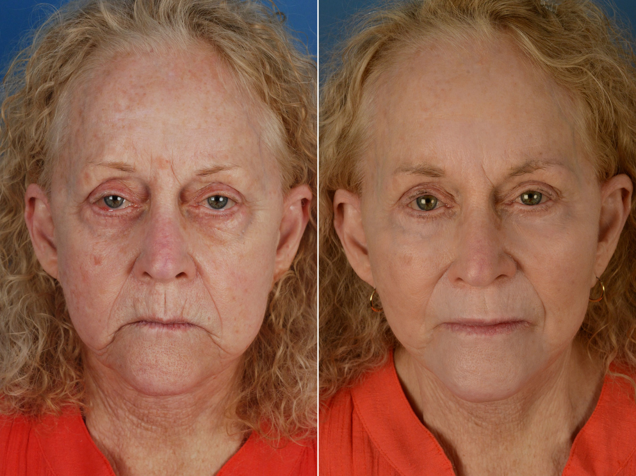 Endoscopic Facelift Photos Naples, FL Patient 12660