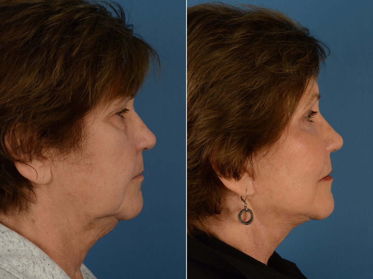 Endoscopic Facelift Before and After Photos in Naples, FL, Patient 12698