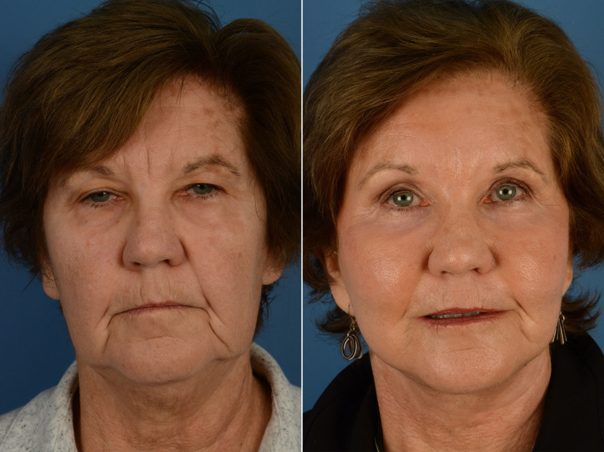 Endoscopic Facelift Before and After Photos in Naples, FL, Patient 12698