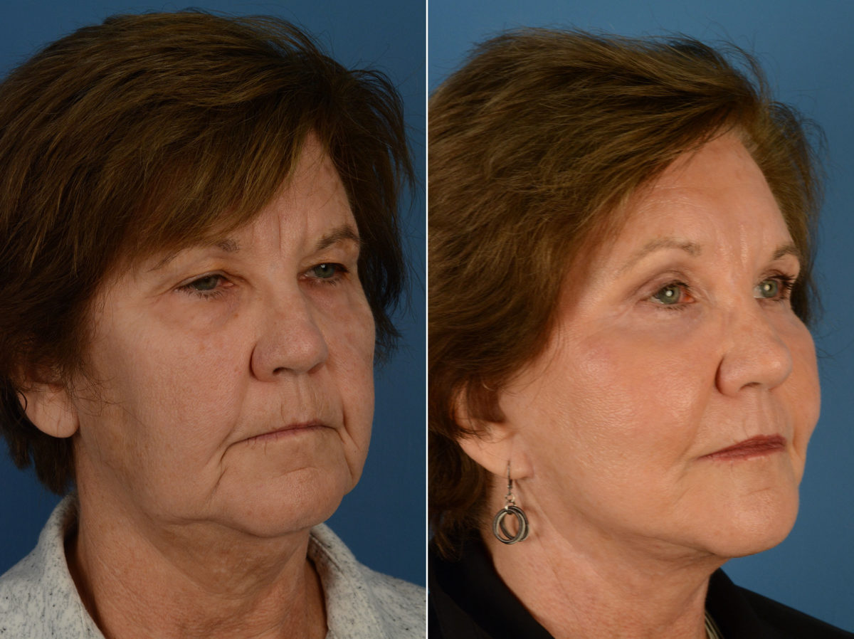 Endoscopic Facelift Before and After Photos in Naples, FL, Patient 12698