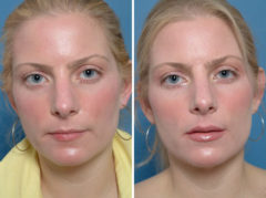 Injectable Fillers Before and After Photos in Naples, FL, Patient 12751