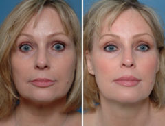 Injectable Fillers Before and After Photos in Naples, FL, Patient 12756