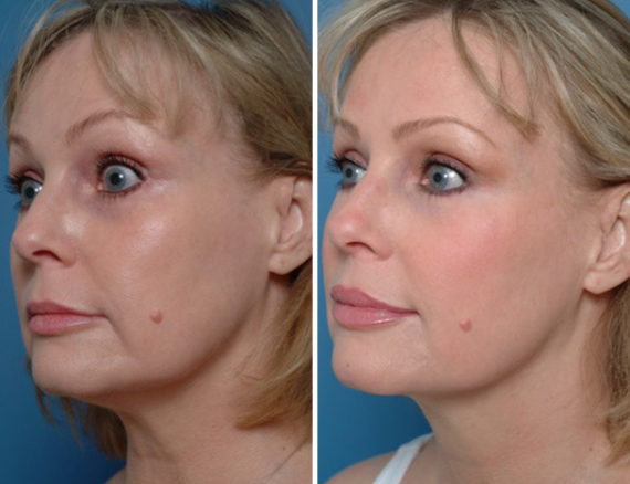 Injectable Fillers Before and After Photos in Naples, FL, Patient 12756