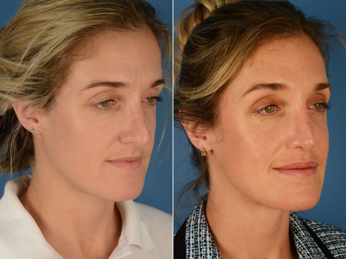 Revision Rhinoplasty Before and After Photos in Naples, FL, Patient 12873