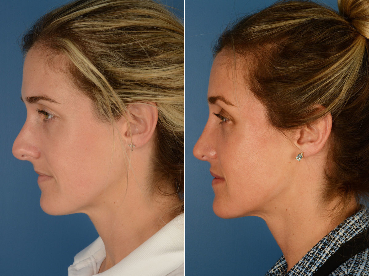 Revision Rhinoplasty Before and After Photos in Naples, FL, Patient 12873