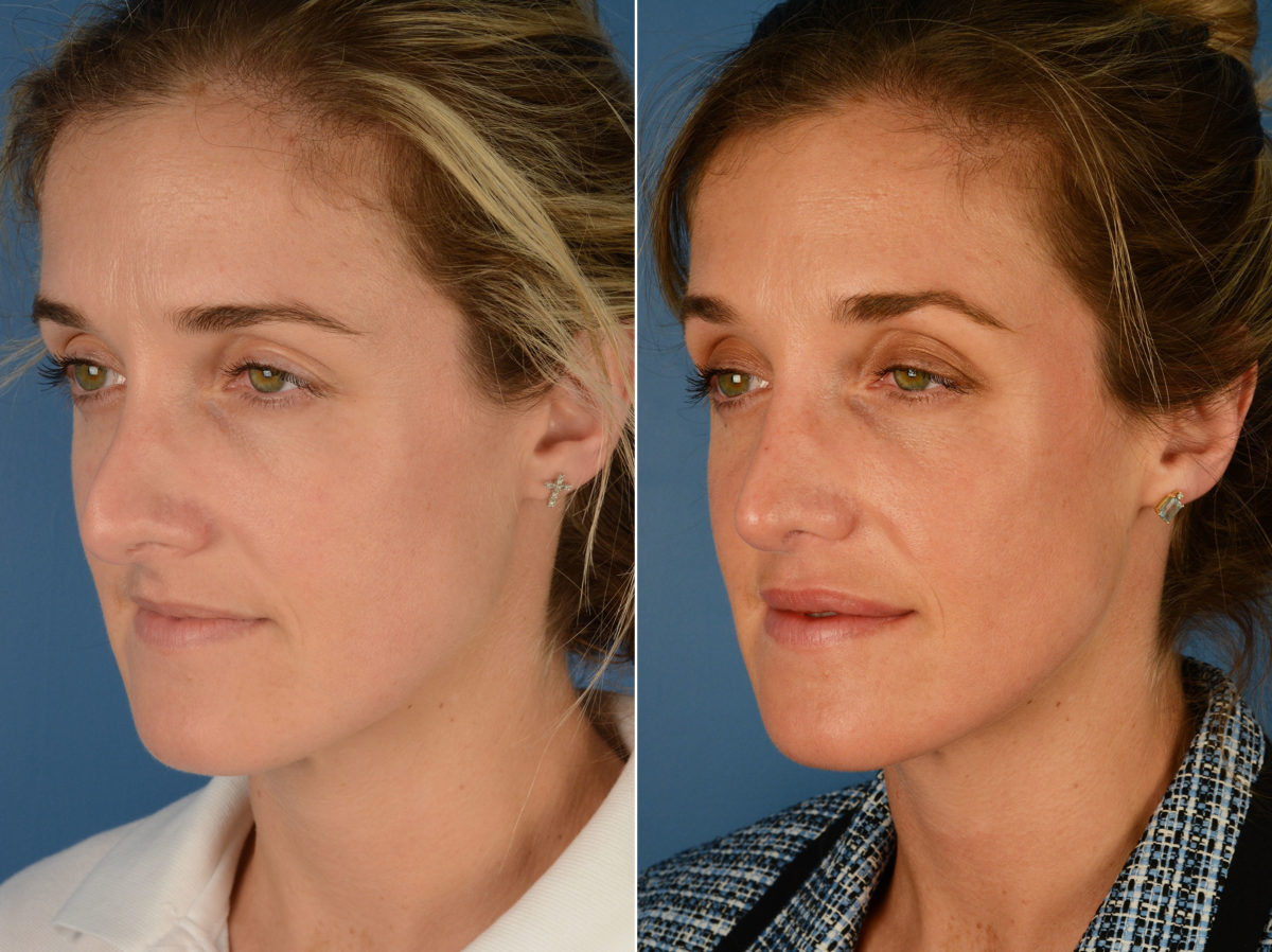 Revision Rhinoplasty Before and After Photos in Naples, FL, Patient 12873