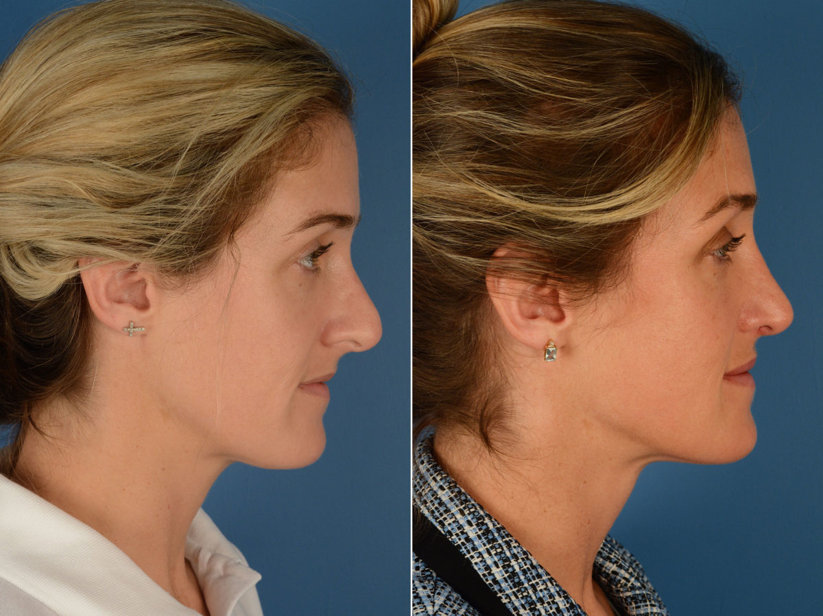 Revision Rhinoplasty Before and After Photos in Naples, FL, Patient 12873