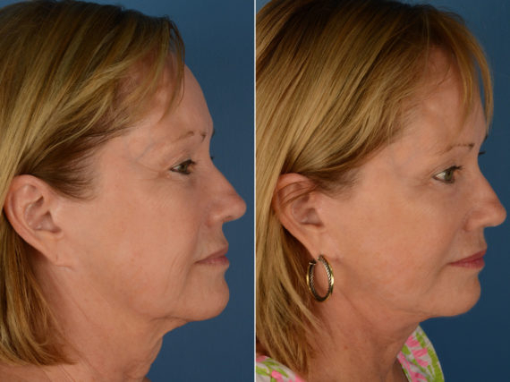 Endoscopic Facelift Before and After Photos in Naples, FL, Patient 12944