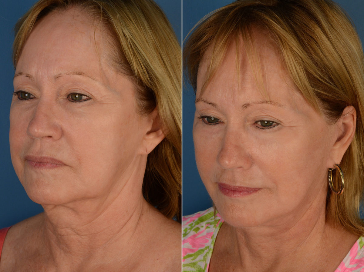 Endoscopic Facelift Before and After Photos in Naples, FL, Patient 12944