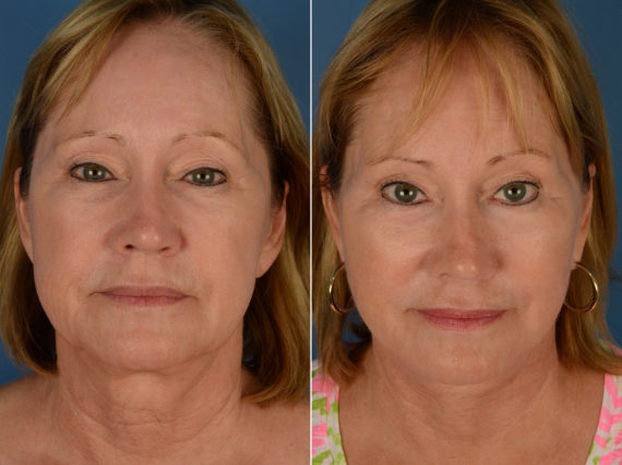 Endoscopic Facelift Before and After Photos in Naples, FL, Patient 12944