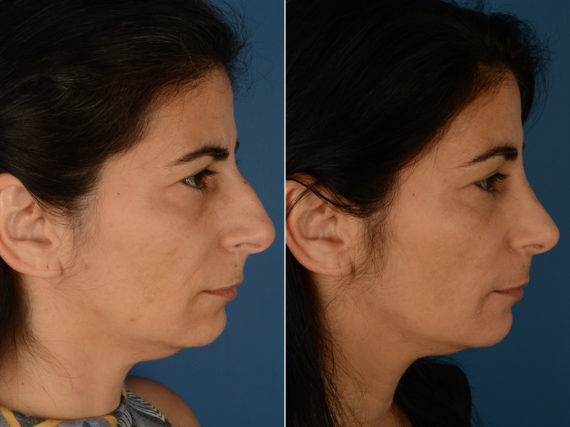 Revision Rhinoplasty Before and After Photos in Naples, FL, Patient 12987