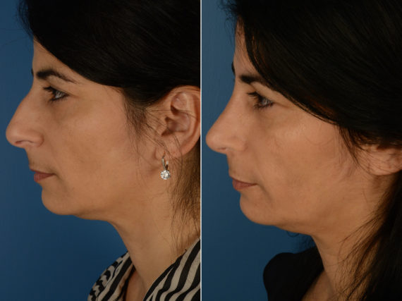 Revision Rhinoplasty Before and After Photos in Naples, FL, Patient 12987