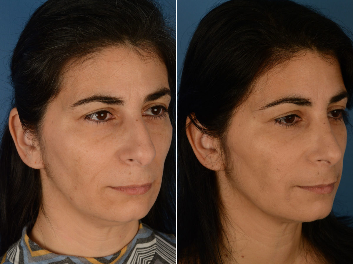 Revision Rhinoplasty Before and After Photos in Naples, FL, Patient 12987