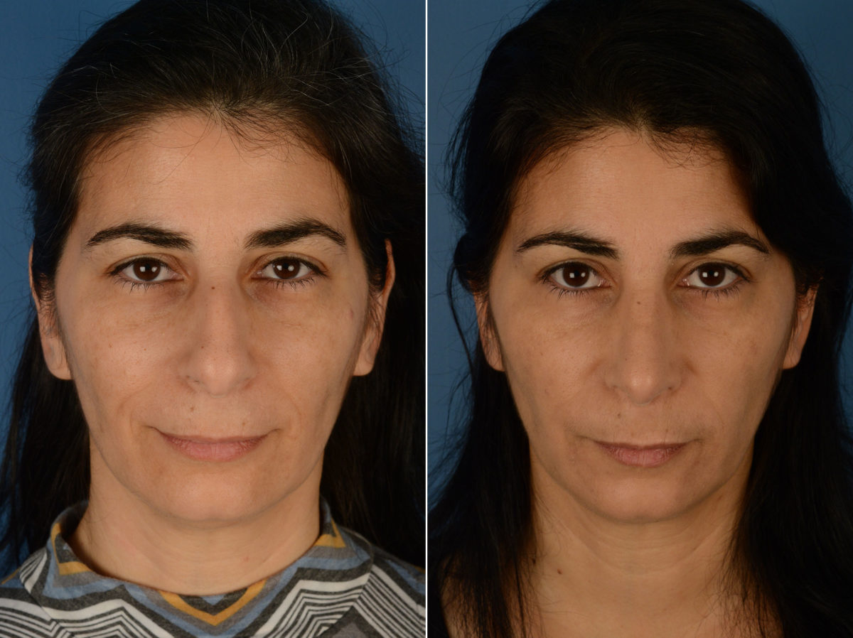 Revision Rhinoplasty Before and After Photos in Naples, FL, Patient 12987
