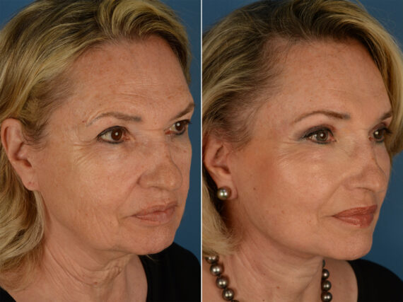 The UpLift™ Lower Face and Neck Lift Before and After Photos in Naples, FL, Patient 13203