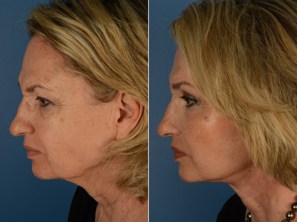 Eyebrow & Forehead Before and After Photos in Naples, FL, Patient 13203