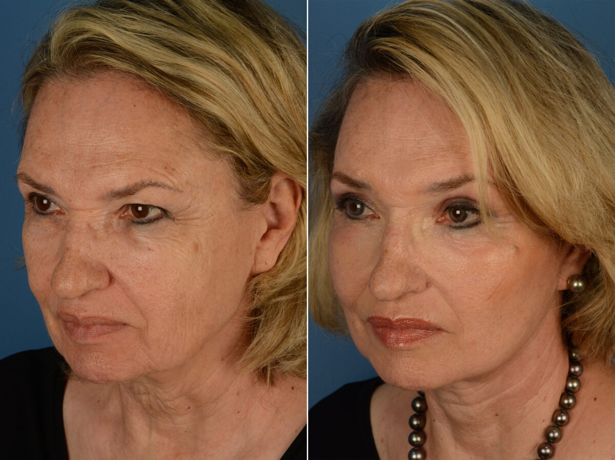Eyebrow & Forehead Before and After Photos in Naples, FL, Patient 13203