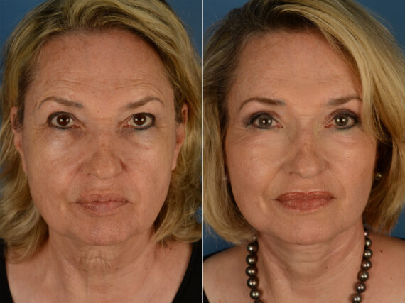 Eyebrow & Forehead Before and After Photos in Naples, FL, Patient 13203