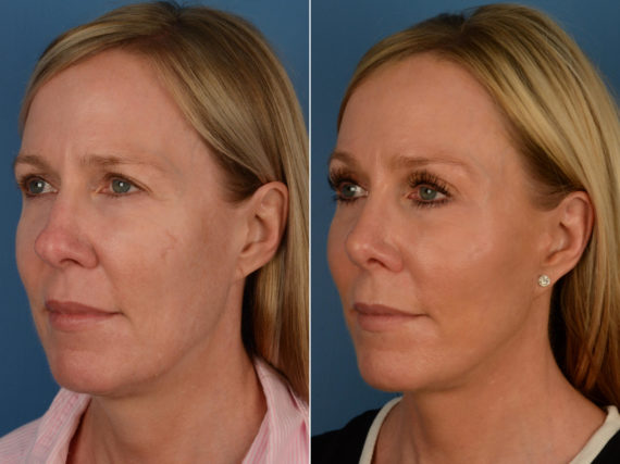 The UpLift™ Lower Face and Neck Lift Before and After Photos in Naples, FL, Patient 13280