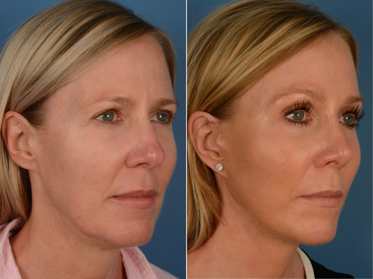 Rhinoplasty Before and After Photos in Naples, FL, Patient 13280