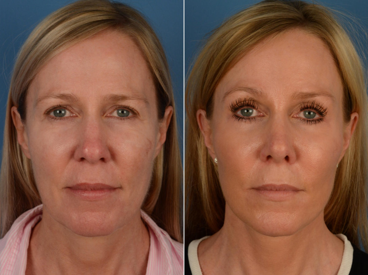 Rhinoplasty Before and After Photos in Naples, FL, Patient 13280