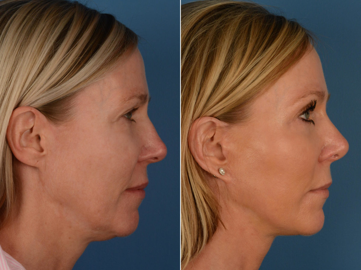 Rhinoplasty Before and After Photos in Naples, FL, Patient 13280