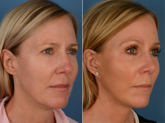 The UpLift™ Lower Face and Neck Lift Before and After Photos in Naples, FL, Patient 13280