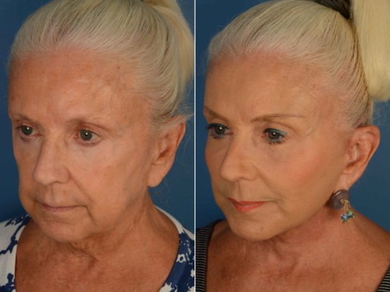 Endoscopic Facelift Before and After Photos in Naples, FL, Patient 13361