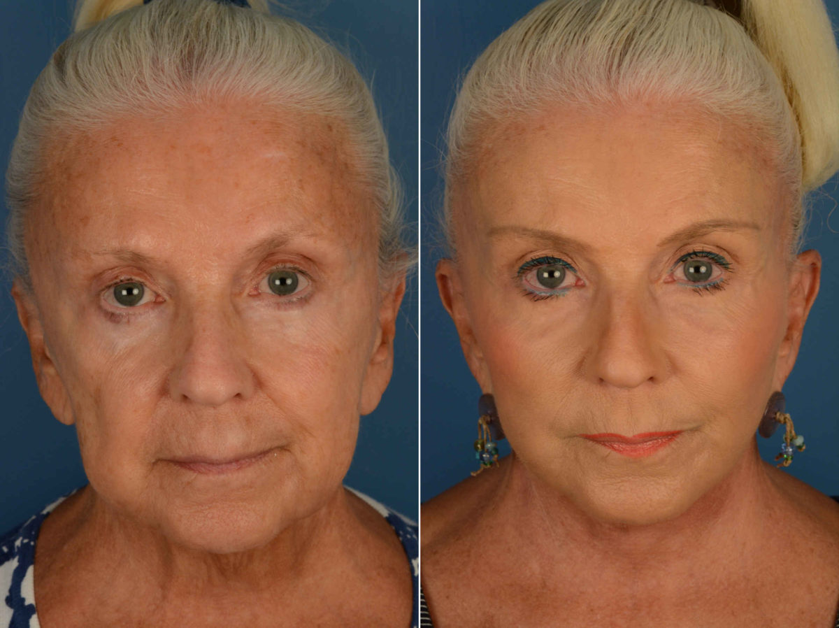 Endoscopic Facelift Before and After Photos in Naples, FL, Patient 13361