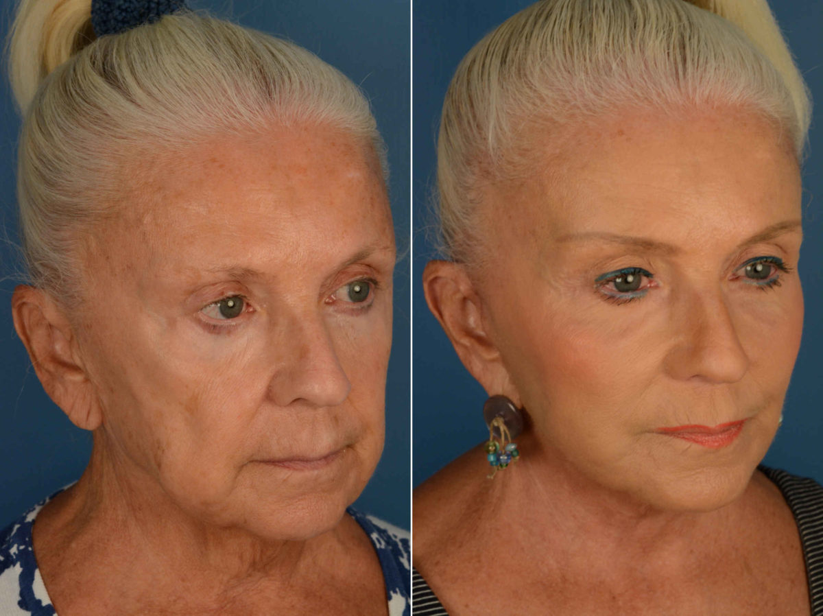 Endoscopic Facelift Before and After Photos in Naples, FL, Patient 13361