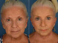 Endoscopic Facelift Before and After Photos in Naples, FL, Patient 13361