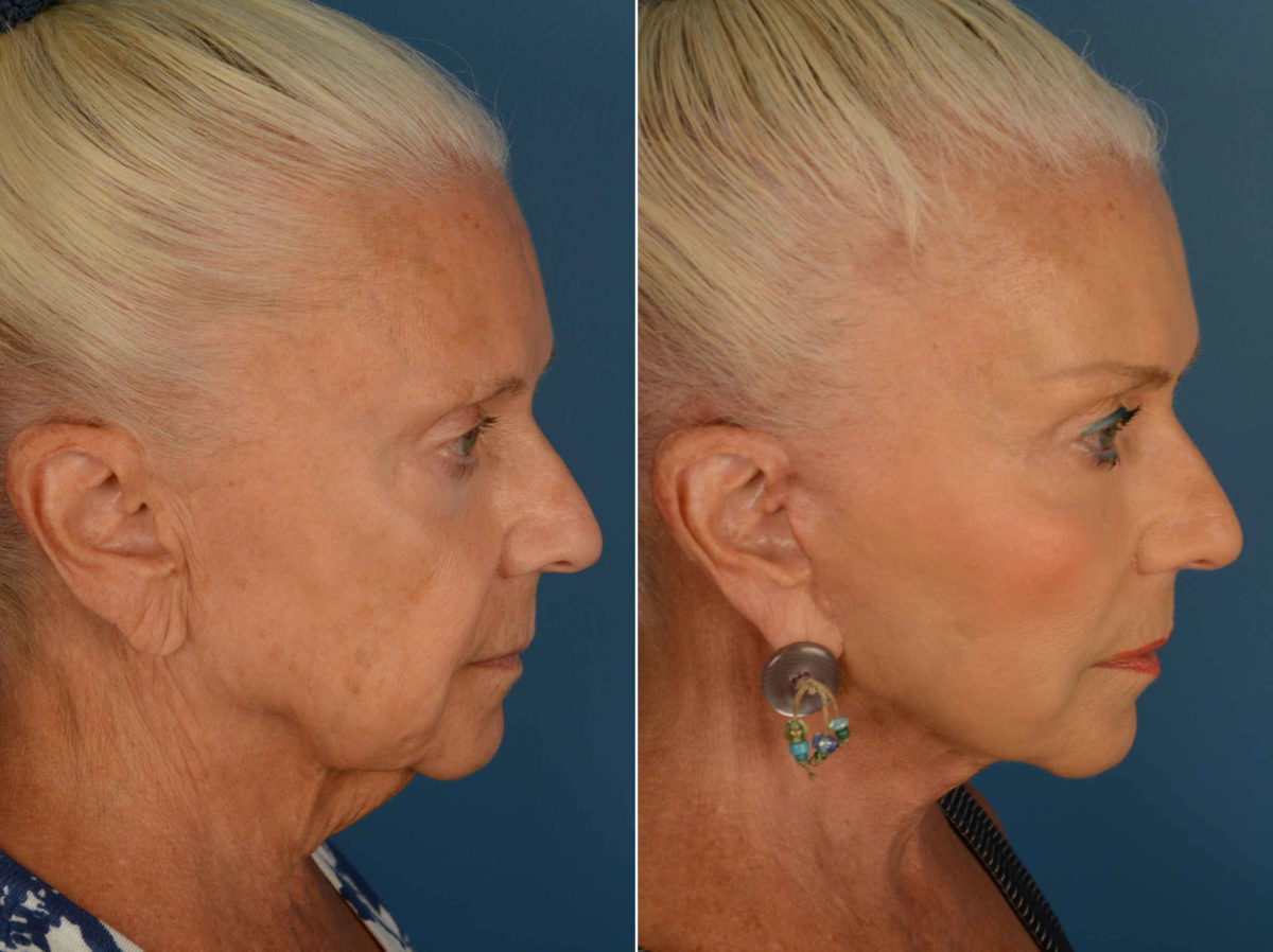 Endoscopic Facelift Before and After Photos in Naples, FL, Patient 13361