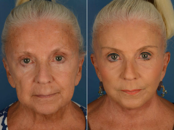 Endoscopic Facelift Before and After Photos in Naples, FL, Patient 13361