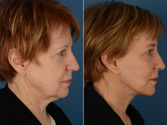 Endoscopic Facelift Before and After Photos in Naples, FL, Patient 13484