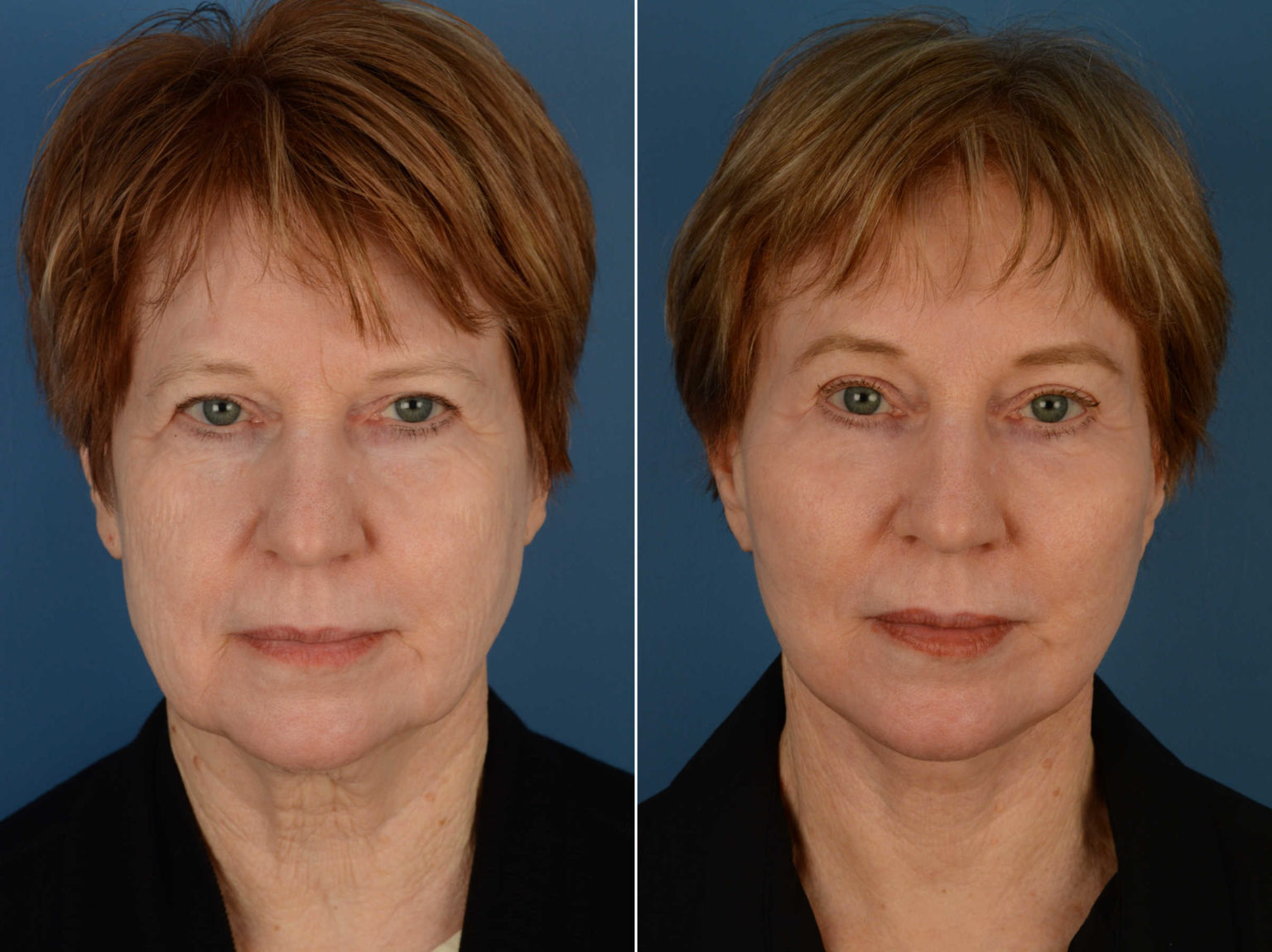 Endoscopic Facelift Photos Naples, FL Patient 13484