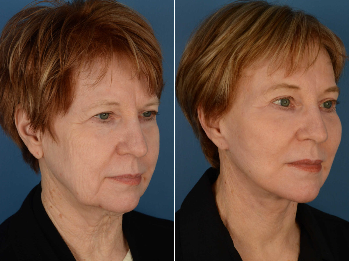 Endoscopic Facelift Before and After Photos in Naples, FL, Patient 13484