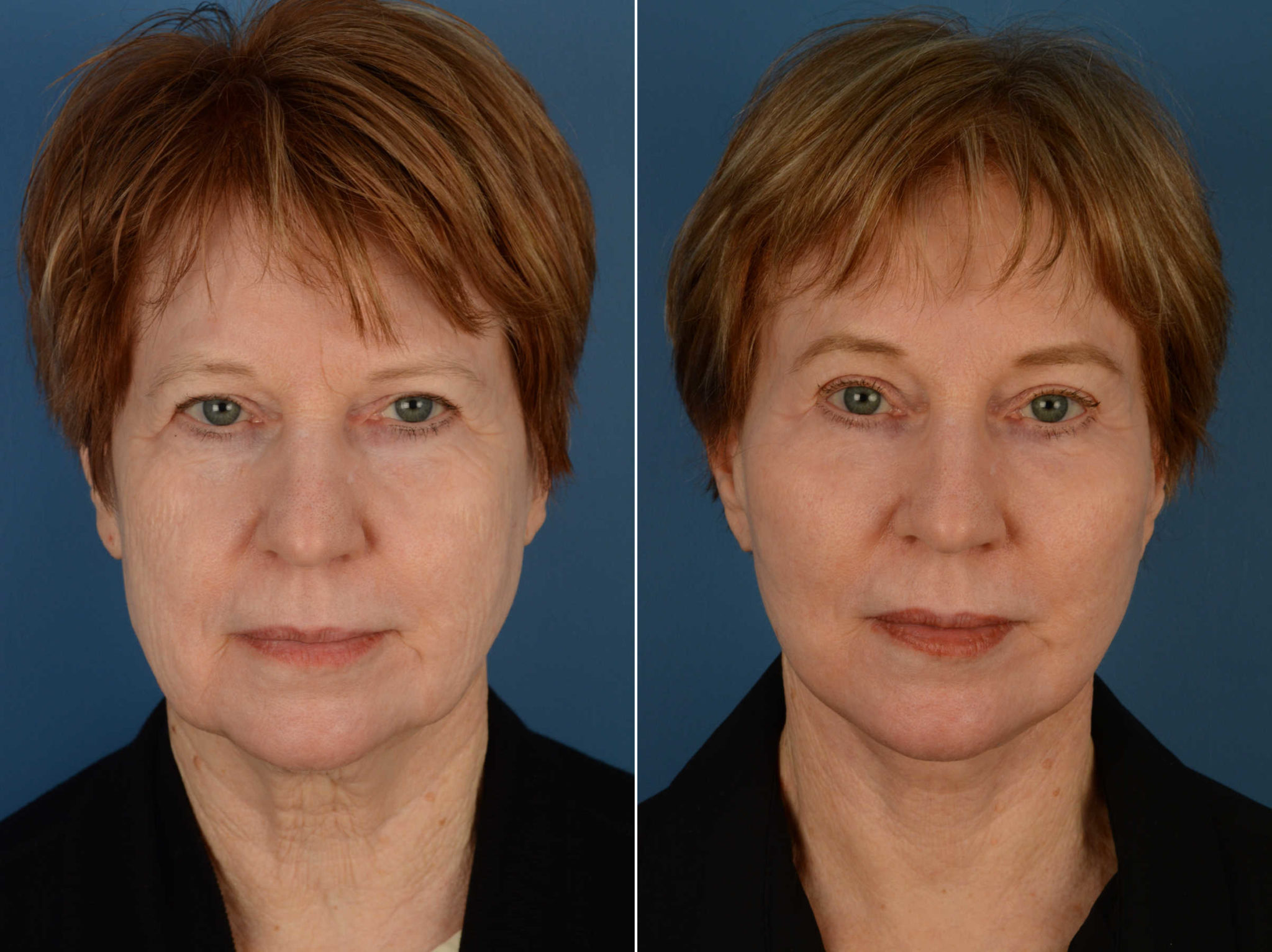 Endoscopic Facelift Photos Naples, FL Patient 13484