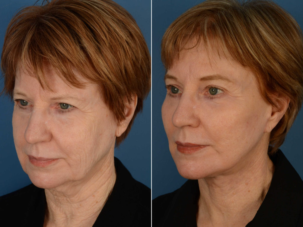 Endoscopic Facelift Photos Naples, FL Patient 13484