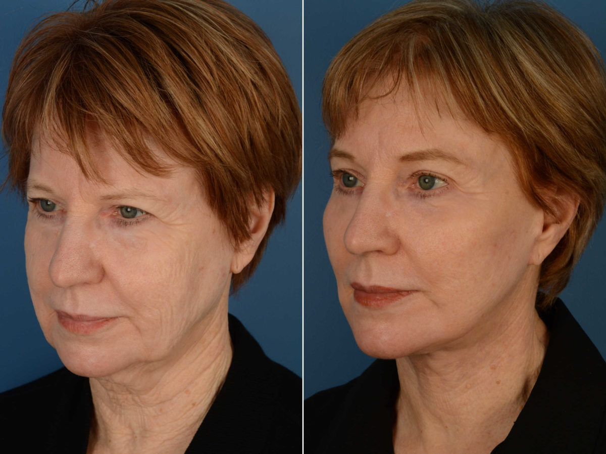 Endoscopic Facelift Before and After Photos in Naples, FL, Patient 13484