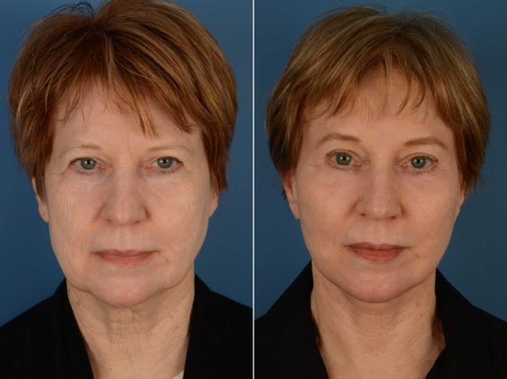 Endoscopic Facelift Before and After Photos in Naples, FL, Patient 13484