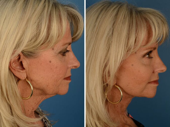 Endoscopic Facelift Before and After Photos in Naples, FL, Patient 13571