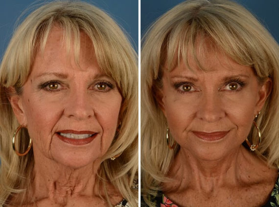 Endoscopic Facelift Before and After Photos in Naples, FL, Patient 13571