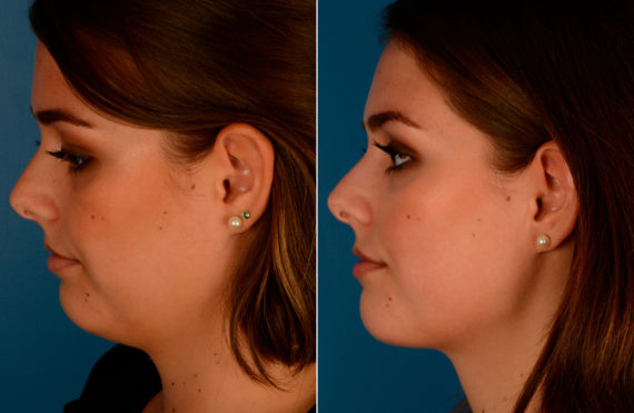 Neck Liposuction Before and After Photos in Naples, FL, Patient 13637