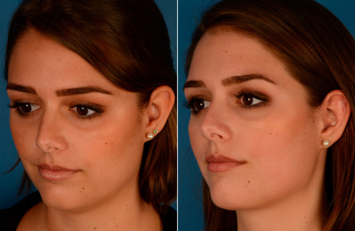Neck Liposuction Before and After Photos in Naples, FL, Patient 13637